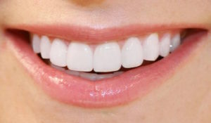 veneers right for you