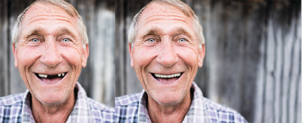 man's smile is restored thanks to dental implants from Allred Dental