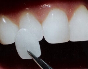 cosmetic porcelain veneers