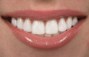 maintain porcelain veneers