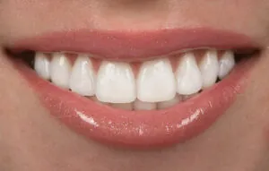 maintain porcelain veneers