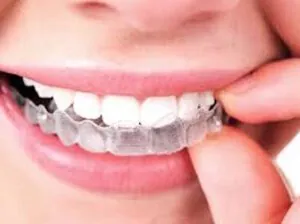 invisalign clear smile