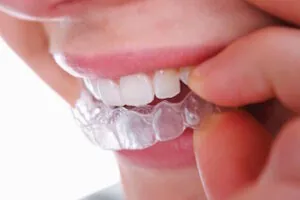 invisalign treatment