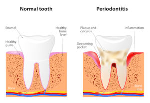 signs of periodontal disease
