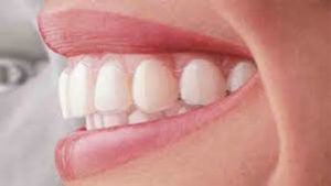 straighter smile with invisalign