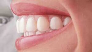 straighter smile with invisalign