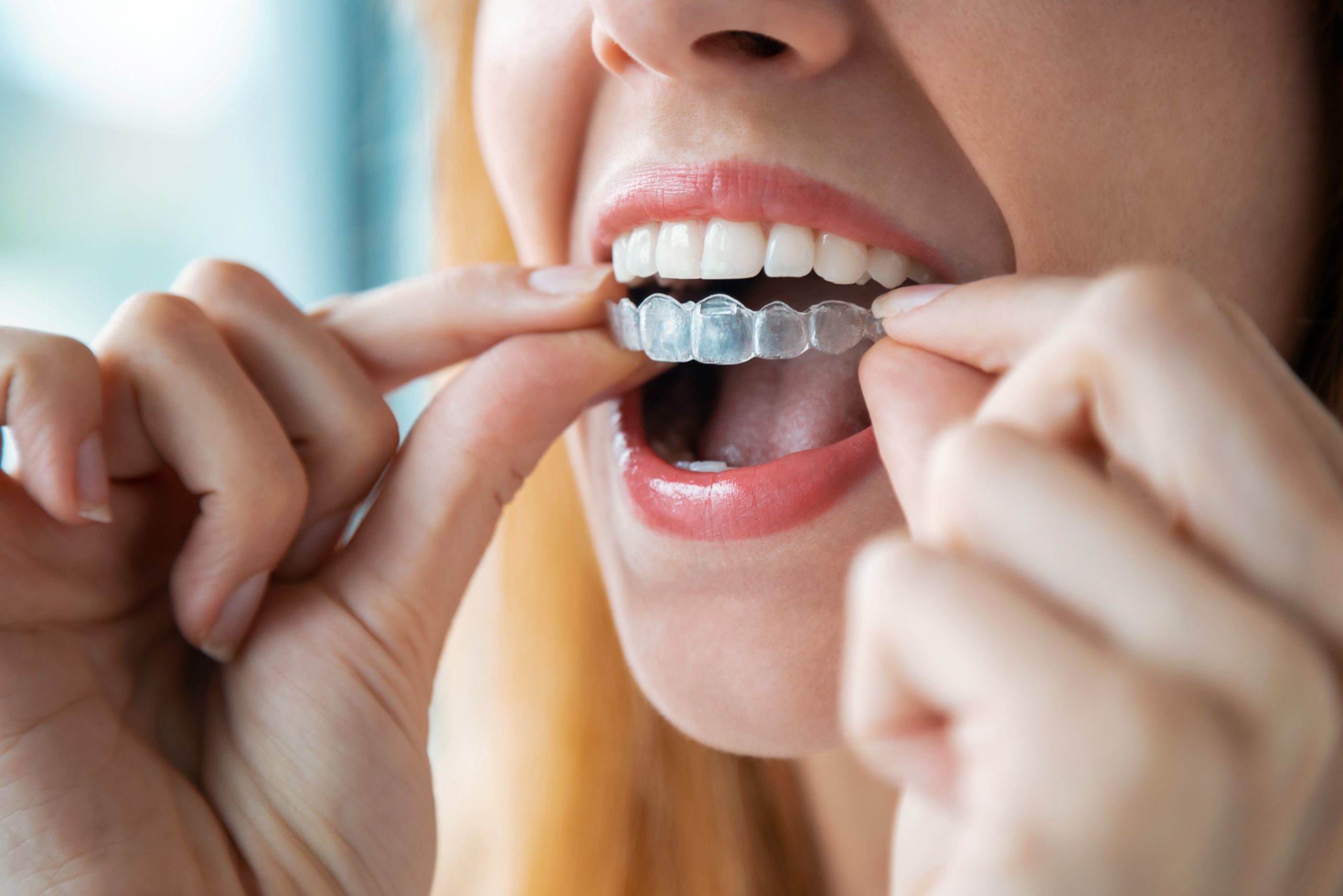 woman inserting her Invisalign clear aligners