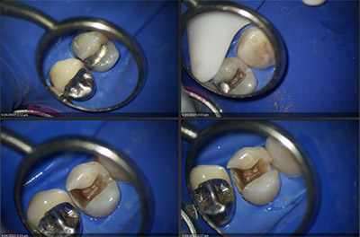 dental crowns made at Allred Dental